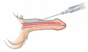 Instealladh aigéad hyaluronic
